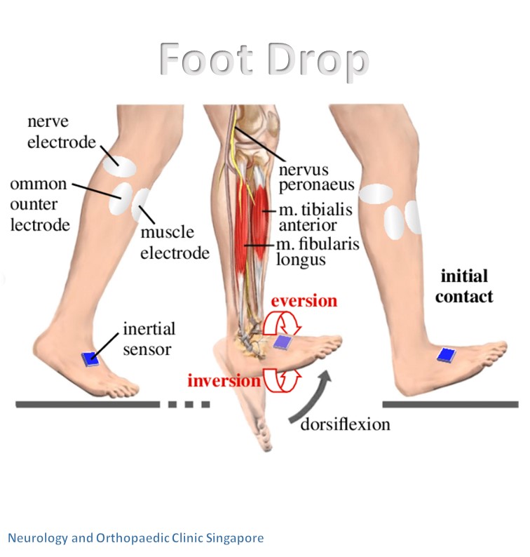 Foot drop info