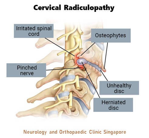 Cervical Radiculopathy info