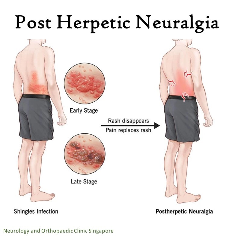 Post Herpetic Neuralgia info