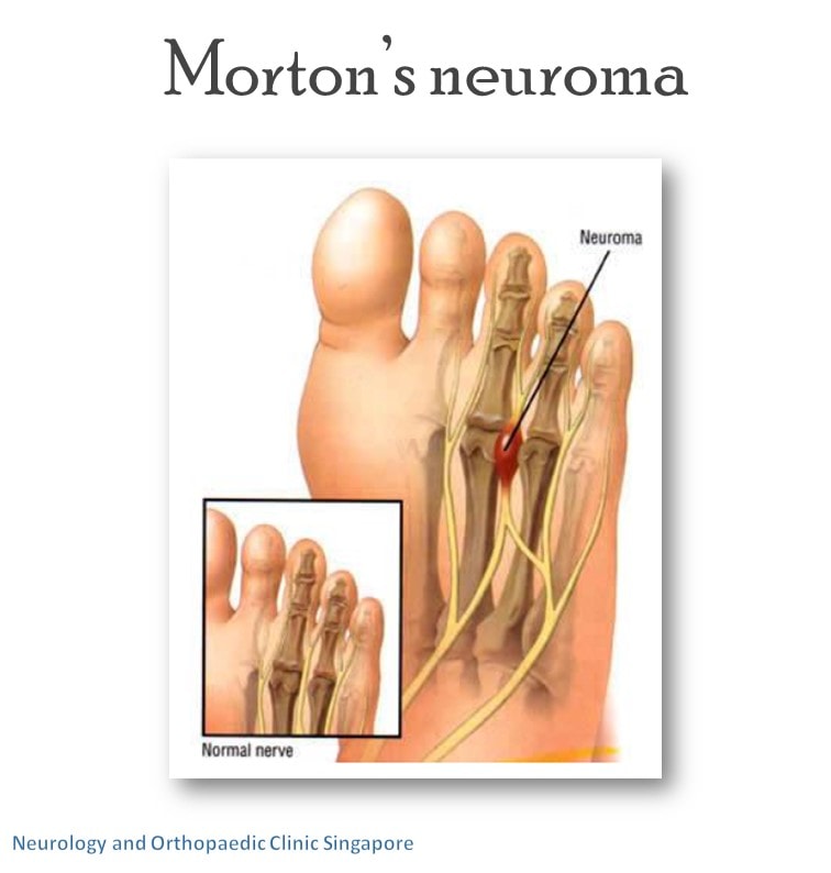 Morton’s neuroma info