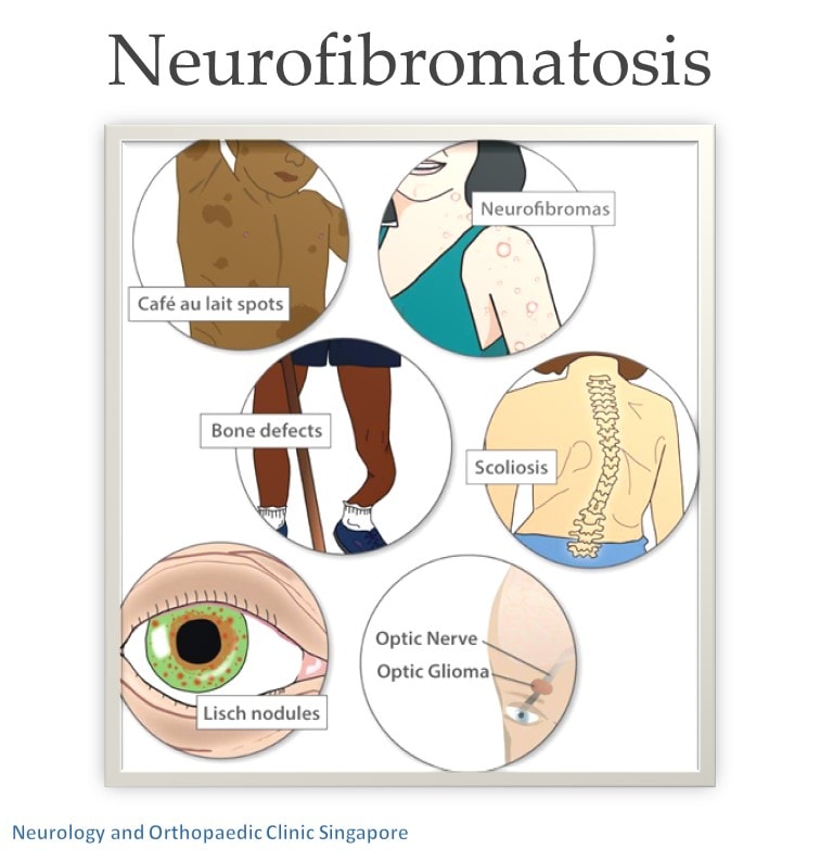 Neurofibromatosis info