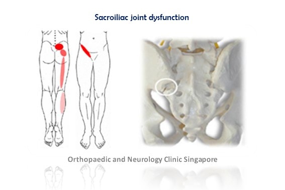 Sacroiliac joint dysfunction info 2